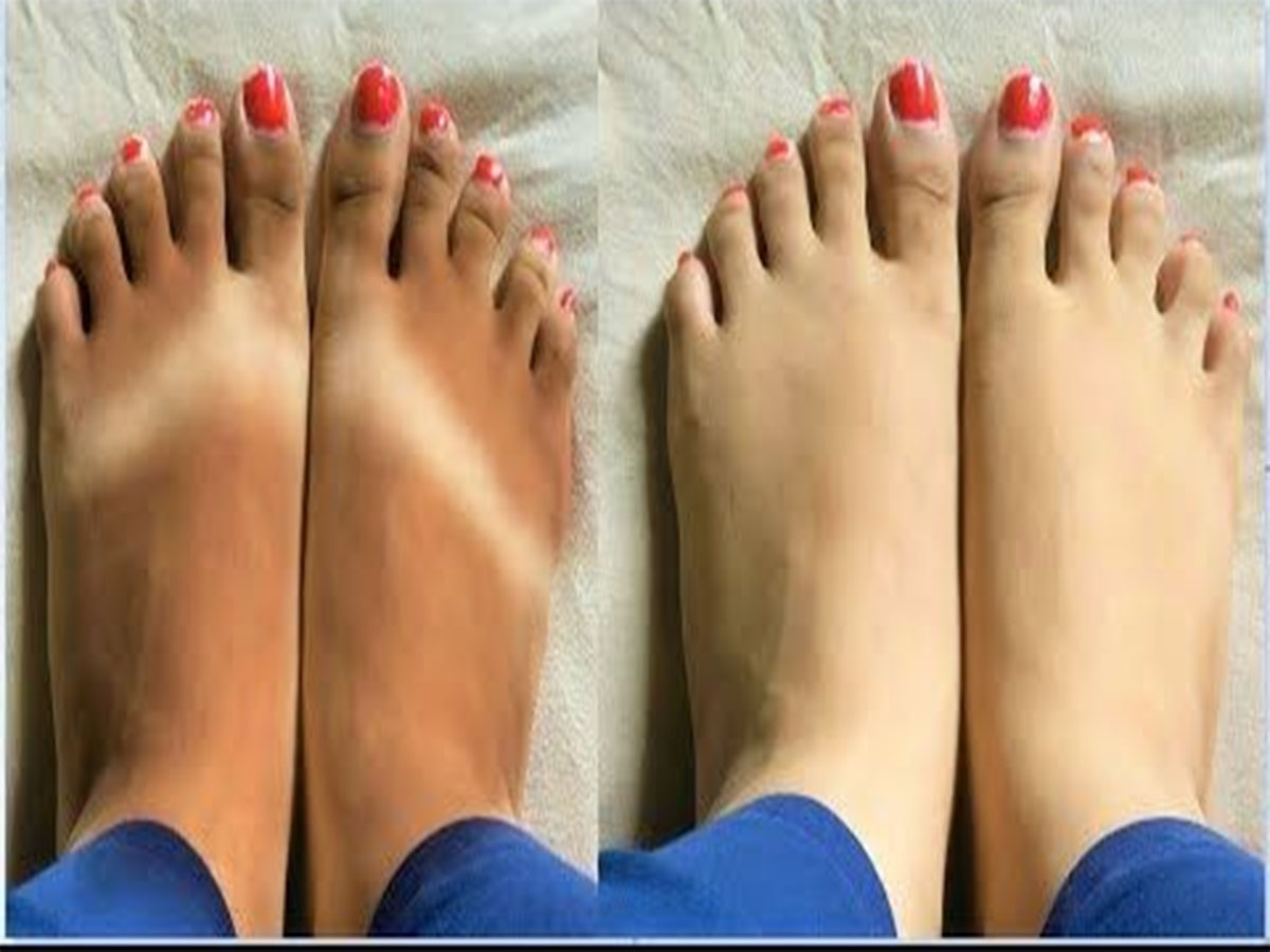 Tanning: એકવારમાં દુર થશે તડકાના કારણે હાથ-પગ પર થયેલું ટેનિંગ, આ 5 વસ્તુથી ફટાફટ નોર્મલ થઈ જાય છે સ્કિન