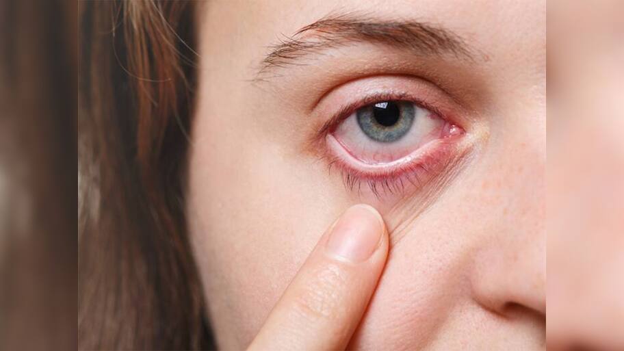 Dry Eye Syndrome: કલાકો સુધી રીલ્સ જોવાની આદત આંખ માટે મોટું જોખમ, તાત્કાલીક વાંચો આ ચેતવણી