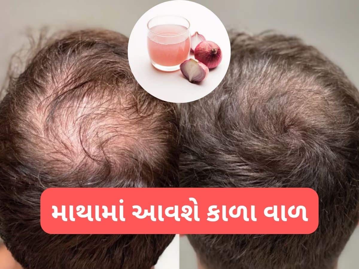 Hair Care: ડુંગળીના રસમાં આ વસ્તુ મિક્સ કરી ત્યાં લગાડો જ્યાંથી વાળ ખરી ગયા હોય, થોડા જ દિવસમાં કાળા વાળ દેખાવા લાગશે