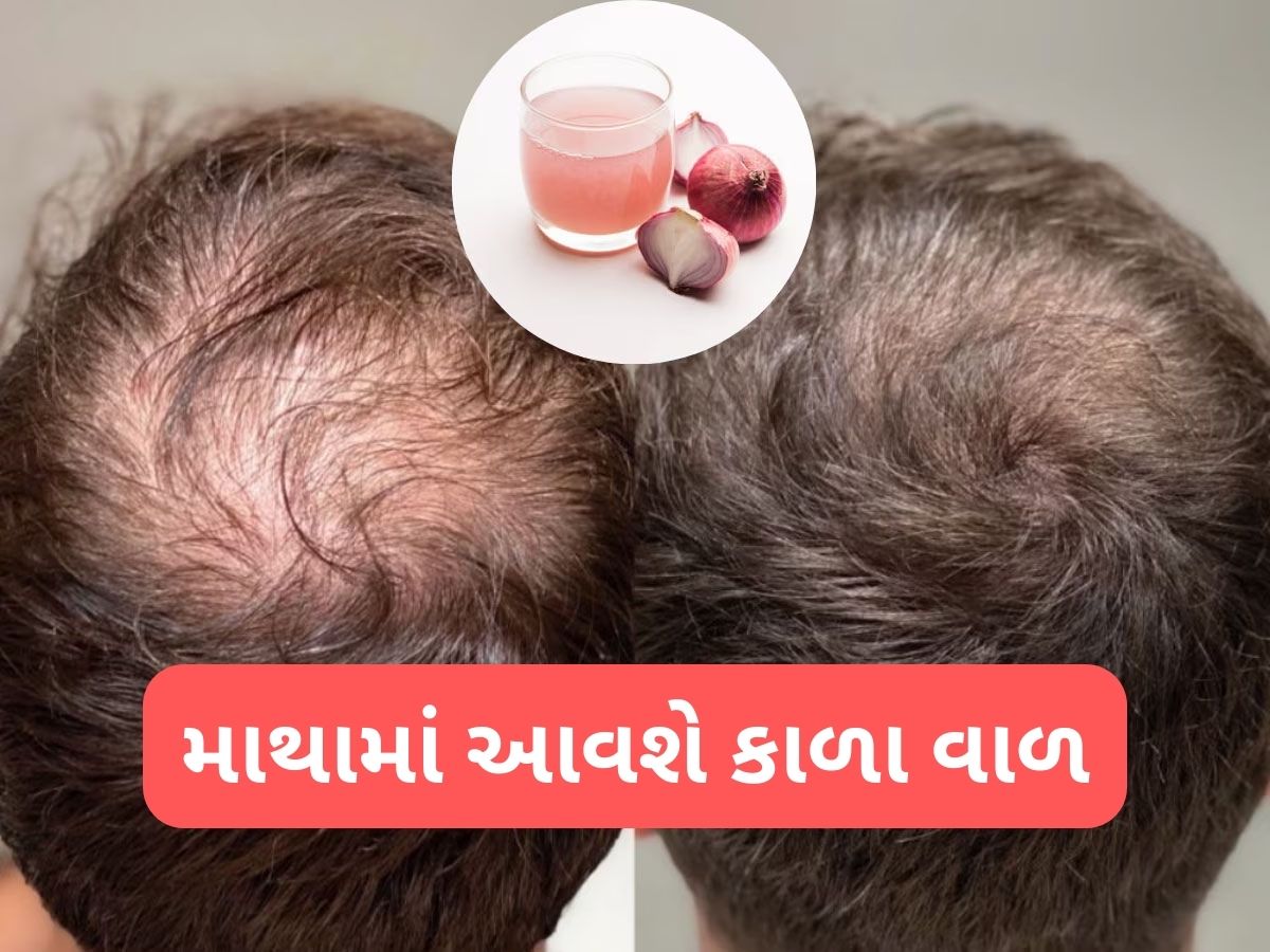 Hair Care: ડુંગળીના રસમાં આ વસ્તુ મિક્સ કરી ત્યાં લગાડો જ્યાંથી વાળ ખરી ગયા હોય, થોડા જ દિવસમાં કાળા વાળ દેખાવા લાગશે Hair Care: ડુંગળીના રસમાં આ વસ્તુ મિક્સ કરી ત્યાં લગાડો જ્યાંથી વાળ ખરી ગયા હોય, થોડા જ દિવસમાં કાળા વાળ દેખાવા લાગશે
