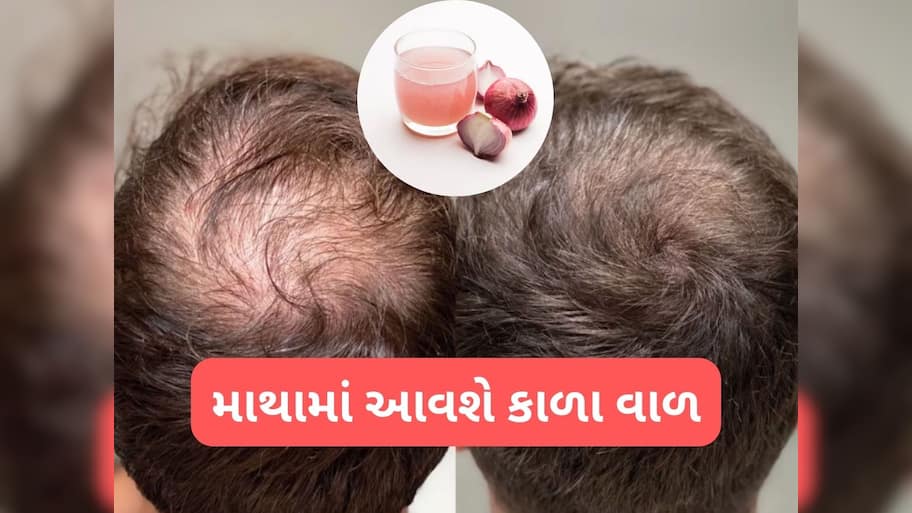 Hair Care: ડુંગળીના રસમાં આ વસ્તુ મિક્સ કરી ત્યાં લગાડો જ્યાંથી વાળ ખરી ગયા હોય, થોડા જ દિવસમાં કાળા વાળ દેખાવા લાગશે