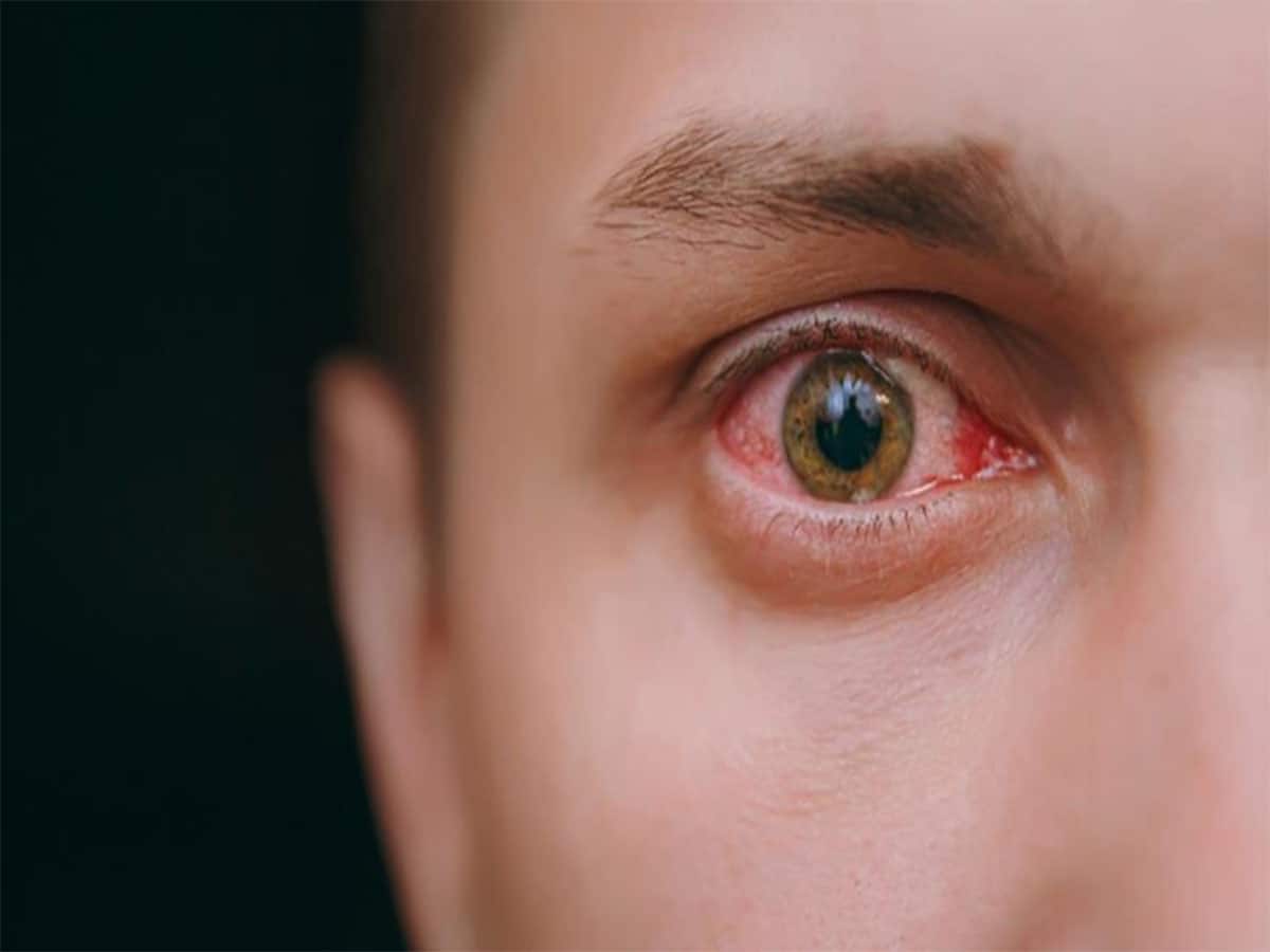 Red Eyes: સવારે જાગો ત્યારે આંખ લાલ હોવી આ બીમારીનું શરુઆતી લક્ષણ, ઈગ્નોર કરવાની ભુલ ન કરવી