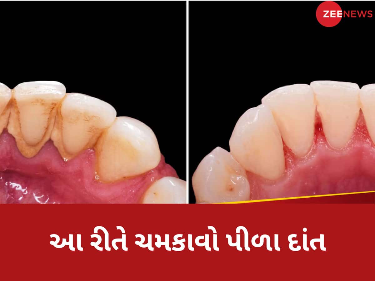 ગુટકા-પાન ખાઈને ગંદા પીળા થઈ ગયા છે દાંત? મોતી જેવા ચમકાવવા માટે અજમાવો આ ઘરગથ્થું ઉપાય