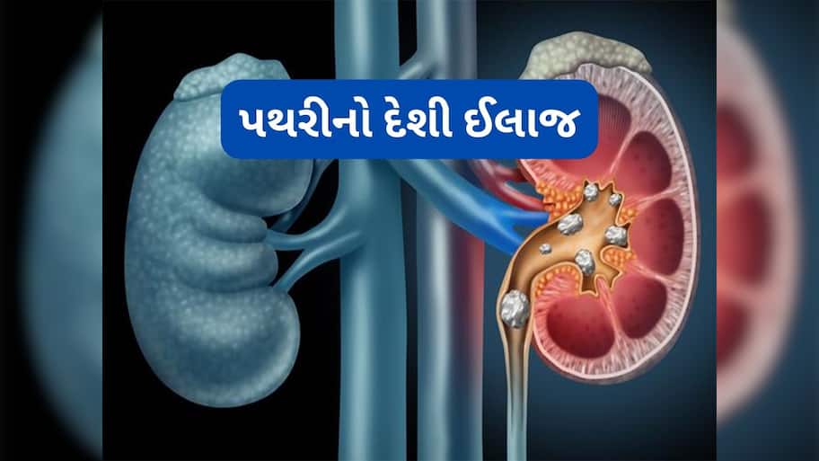 Kidney Stone: પથરી કાઢવાનો વર્ષો જુનો આયુર્વેદિક નુસખો, રોજ સવારે પી લેવું આ ખાસ ડ્રિંક