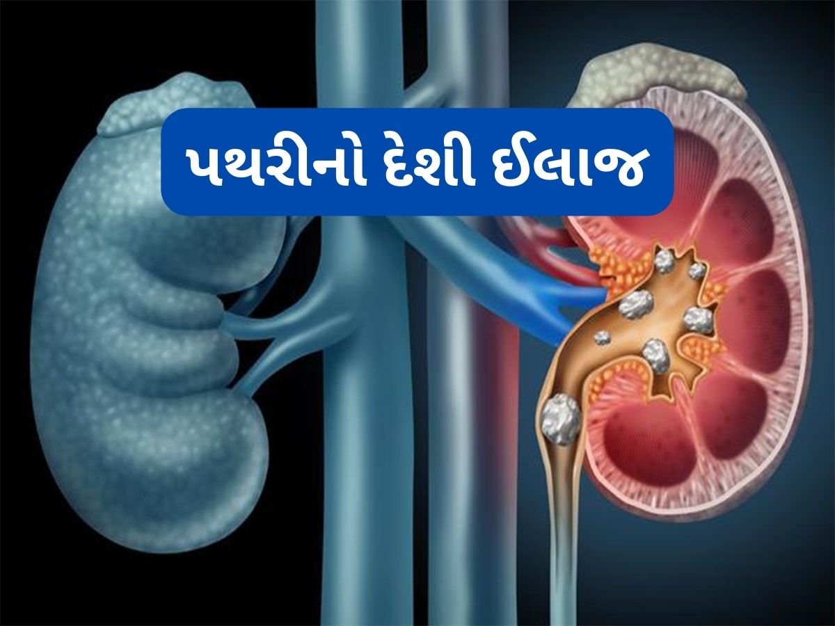 Kidney Stone: પથરી કાઢવાનો વર્ષો જુનો આયુર્વેદિક નુસખો, રોજ સવારે પી લેવું આ ખાસ ડ્રિંક Kidney Stone: પથરી કાઢવાનો વર્ષો જુનો આયુર્વેદિક નુસખો, રોજ સવારે પી લેવું આ ખાસ ડ્રિંક