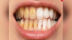 Yellow Teeth: પીળા દાંતને સફેદ કરવાનો અચૂક ઉપાય, આ 2 વસ્તુથી કરો દાંતની સફાઈ
