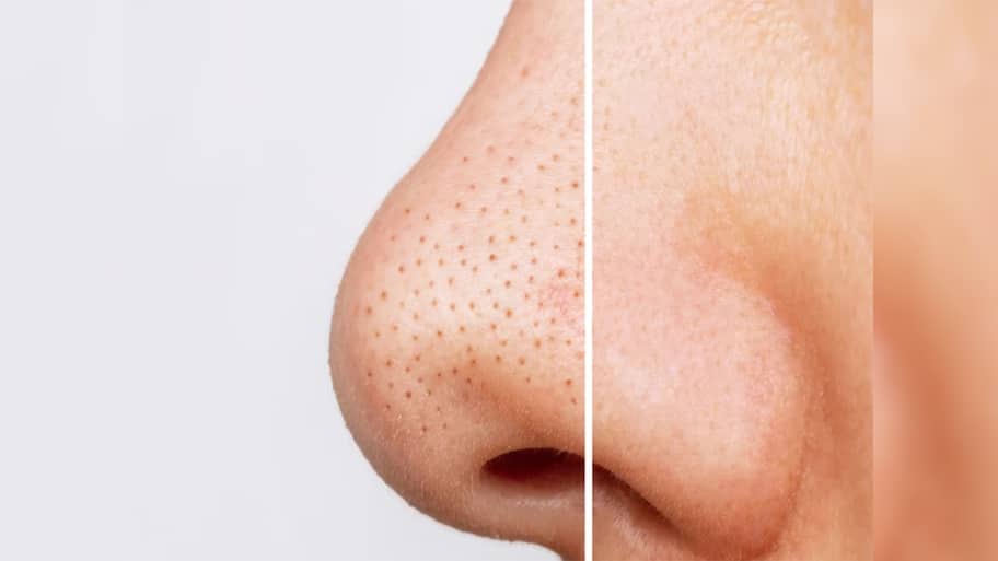 Blackheads: નાક આસપાસના બ્લેકહેડ્સ દુર કરવાની સૌથી સરળ રીત, 5 મિનિટમાં સ્કિન થઈ જાશે ક્લીન