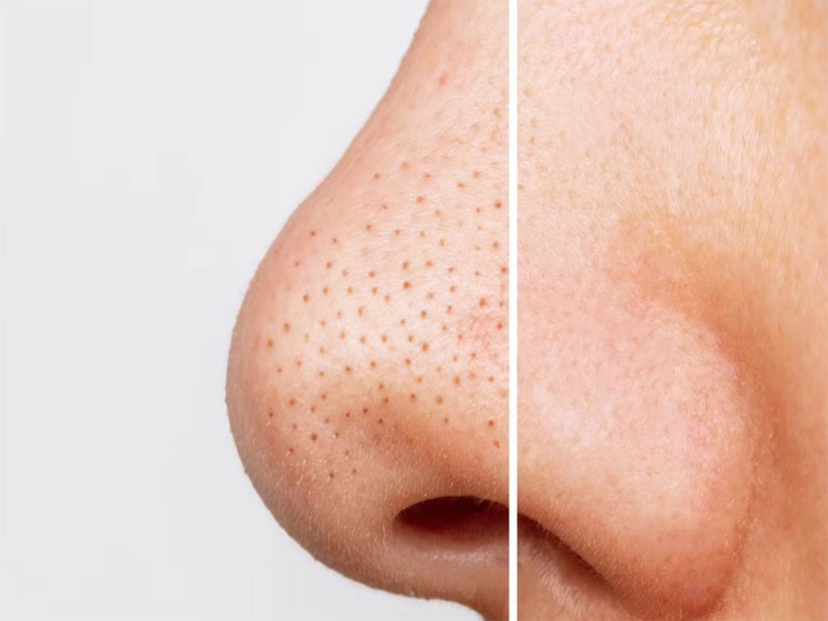 Blackheads: નાક આસપાસના બ્લેકહેડ્સ દુર કરવાની સૌથી સરળ રીત, 5 મિનિટમાં સ્કિન થઈ જાશે ક્લીન Blackheads: નાક આસપાસના બ્લેકહેડ્સ દુર કરવાની સૌથી સરળ રીત, 5 મિનિટમાં સ્કિન થઈ જાશે ક્લીન