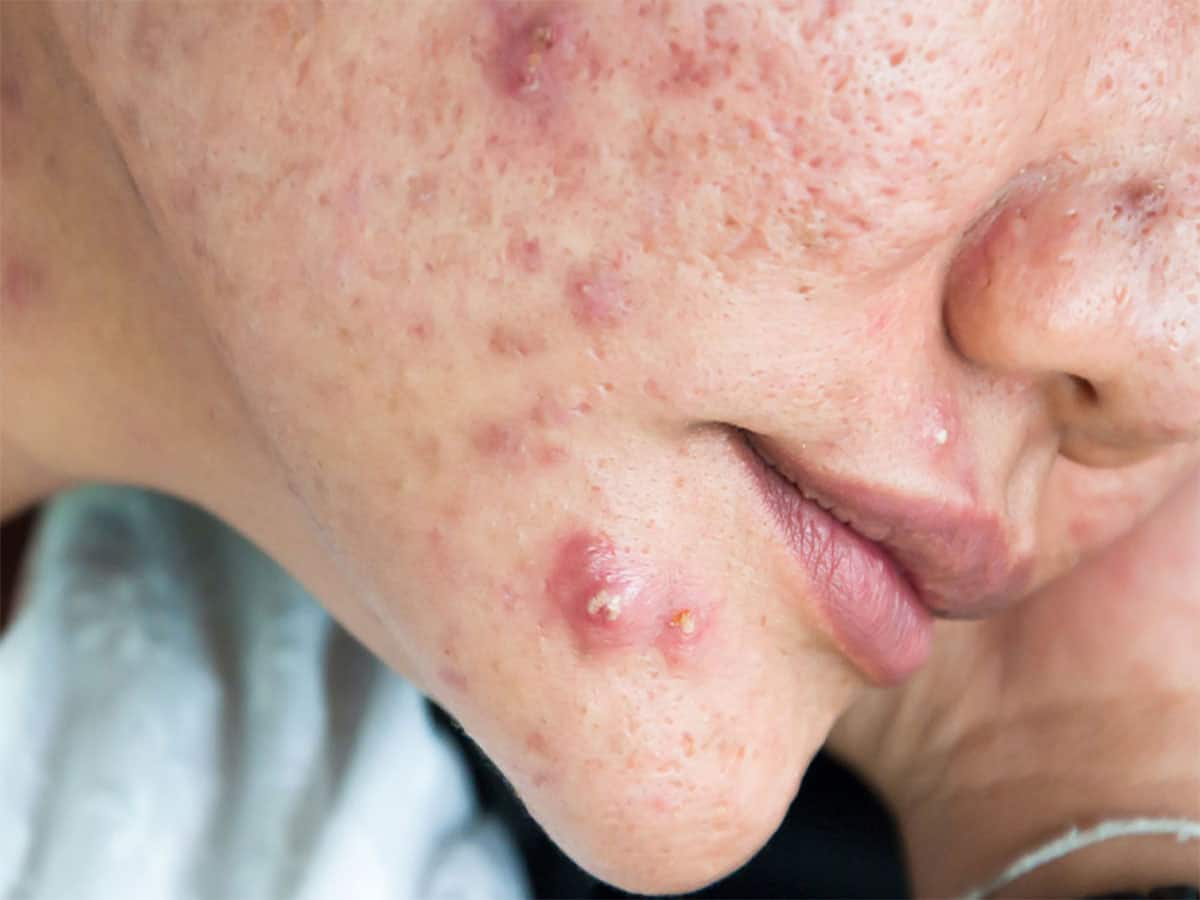 Pimples: એકવાર ખીલ મટશે પછી પાછા નહીં થાય ક્યારેય, અજમાવી જુઓ આ 10 ટીપ્સ