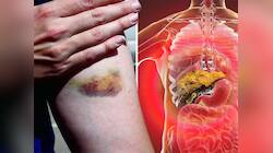Liver Health: ઉનાળામાં ફક્ત ગરમીના કારણે જ નહીં લિવરના રોગના કારણે પણ ભૂખ નથી લાગતી