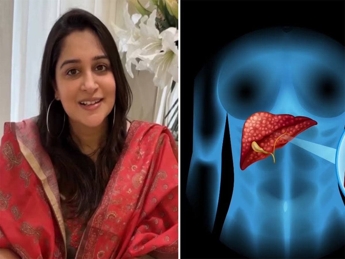 Liver Cancer Symptoms: અભિનેત્રી દીપિકા કક્કડને થયું કેન્સર, લિવર કેન્સરના આ 5 સંકેતોને ઈગ્નોર કરવાની ભુલ કરવી નહીં