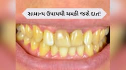 દૂધની જેમ સફેદ થઈ જશે પીળા દાત, બસ આ એક વસ્તુનો કરો ઉપયોગ