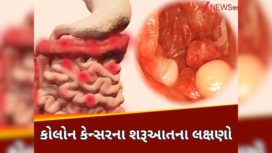 Colon Cancer Symptoms: કોઈ કારણ વગર ઝડપી ઘટી રહ્યું છે વજન તો થઈ જાવ સાવધાન, કોલોન કેન્સરનો હોય શકે છે સંકેત