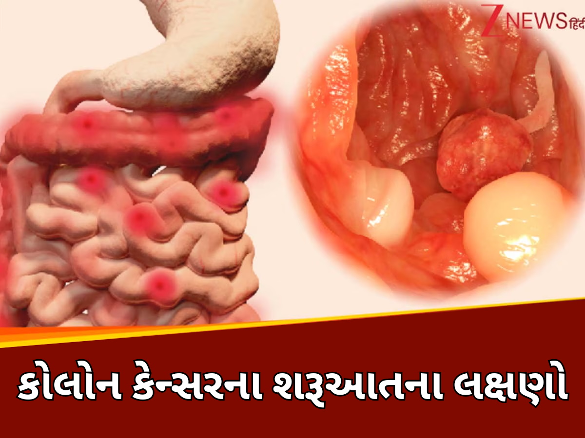 Colon Cancer Symptoms: કોઈ કારણ વગર ઝડપી ઘટી રહ્યું છે વજન તો થઈ જાવ સાવધાન, કોલોન કેન્સરનો હોય શકે છે સંકેત Colon Cancer Symptoms: કોઈ કારણ વગર ઝડપી ઘટી રહ્યું છે વજન તો થઈ જાવ સાવધાન, કોલોન કેન્સરનો હોય શકે છે સંકેત