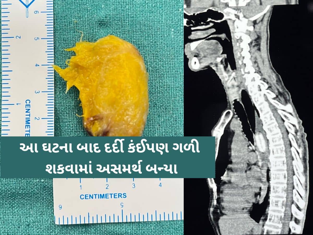 આ 'દાદા'ને કેરીનો સ્વાદ ભારે પડ્યો! ખાતા-ખાતા કેરીનો ગોટલો ગળી ગયા અને પછી થઈ જોવા જેવી.. 