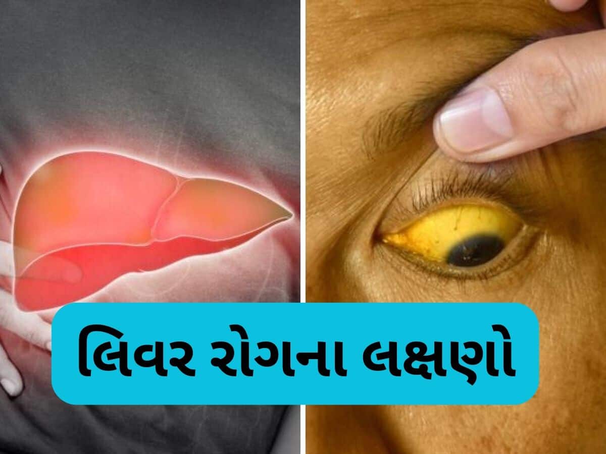   Liver Disease: આ 6 લક્ષણ જણાવશે કે તમારૂ લિવર થઈ ગયું છે ખરાબ, નજરઅંદાજ કરશો તો ભારે પડશે