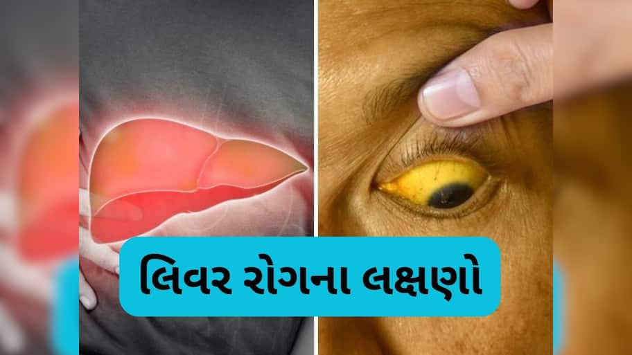   Liver Disease: આ 6 લક્ષણ જણાવશે કે તમારૂ લિવર થઈ ગયું છે ખરાબ, નજરઅંદાજ કરશો તો ભારે પડશે