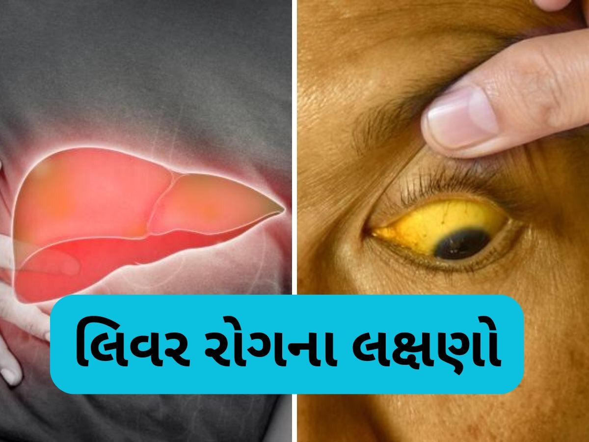 Liver Disease: આ 6 લક્ષણ જણાવશે કે તમારૂ લિવર થઈ ગયું છે ખરાબ, નજરઅંદાજ કરશો તો ભારે પડશે Liver Disease: આ 6 લક્ષણ જણાવશે કે તમારૂ લિવર થઈ ગયું છે ખરાબ, નજરઅંદાજ કરશો તો ભારે પડશે