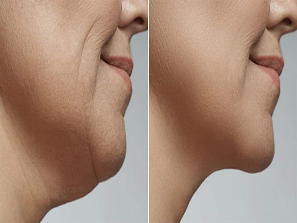 Face Yoga: રોજ સવારે કરી લો આ 5 યોગાસન, ચહેરાની ઢીલી પડેલી સ્કિન પણ ટાઈટ થવા લાગશે