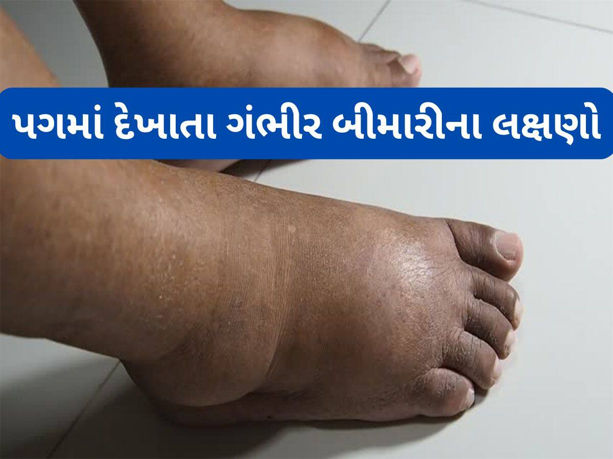 Swelling Feet: પગમાં સોજા સહિત આ 5 ફેરફાર દેખાય તો ડોક્ટર પાસે જવું, ગંભીર બીમારીનું શરુઆતી લક્ષણ હોય શકે છે