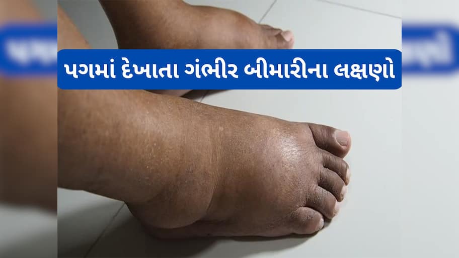 Swelling Feet: પગમાં સોજા સહિત આ 5 ફેરફાર દેખાય તો ડોક્ટર પાસે જવું, ગંભીર બીમારીનું શરુઆતી લક્ષણ હોય શકે છે