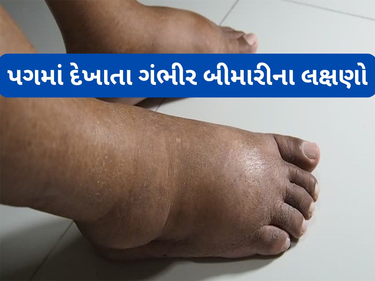 Swelling Feet: પગમાં સોજા સહિત આ 5 ફેરફાર દેખાય તો ડોક્ટર પાસે જવું, ગંભીર બીમારીનું શરુઆતી લક્ષણ હોય શકે છે Swelling Feet: પગમાં સોજા સહિત આ 5 ફેરફાર દેખાય તો ડોક્ટર પાસે જવું, ગંભીર બીમારીનું શરુઆતી લક્ષણ હોય શકે છે