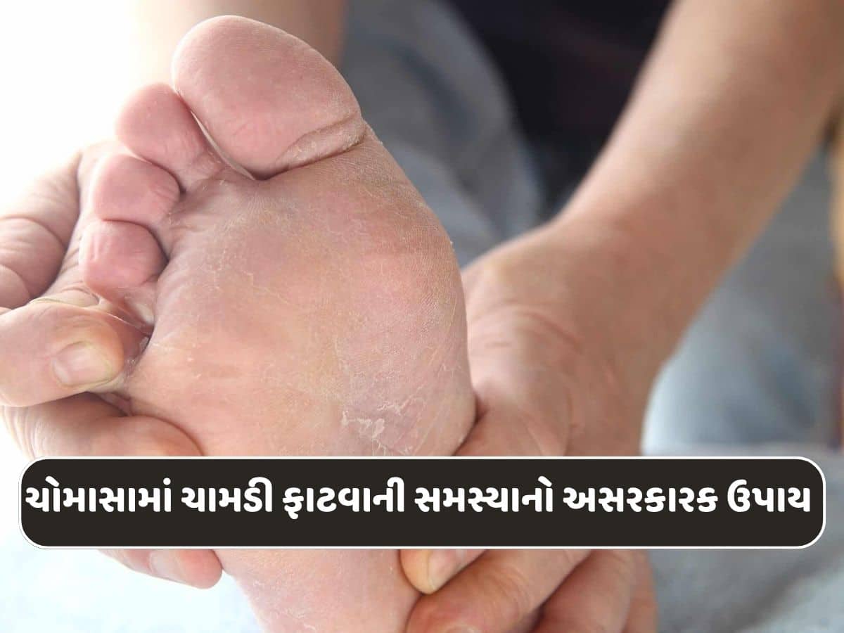 ચોમાસામાં કેમ પગની ચામડી ફાટી જાય છે? આ રહ્યો તેનો ઈલાજ...