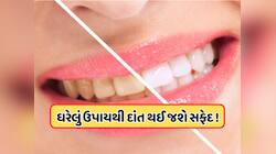 શું તમારા દાંત થઈ ગયા છે પીળા ? આ 2 વસ્તુઓ ઘસો, પીળી ગંદકી સાથે દુર્ગંધ પણ થશે દૂર! 