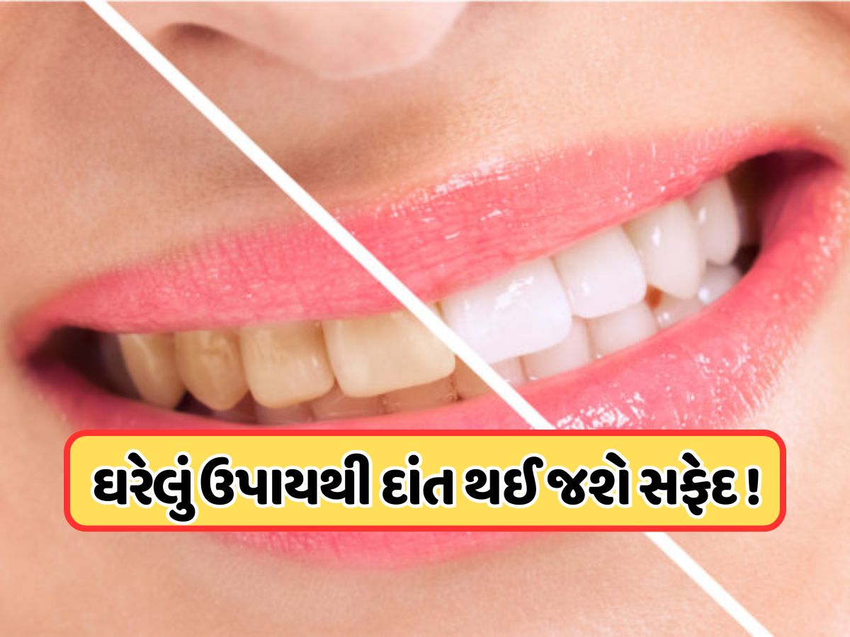 શું તમારા દાંત થઈ ગયા છે પીળા ? આ 2 વસ્તુઓ ઘસો, પીળી ગંદકી સાથે મોઢાની દુર્ગંધ પણ થઈ જશે દૂર ! શું તમારા દાંત થઈ ગયા છે પીળા ? આ 2 વસ્તુઓ ઘસો, પીળી ગંદકી સાથે મોઢાની દુર્ગંધ પણ થઈ જશે દૂર !