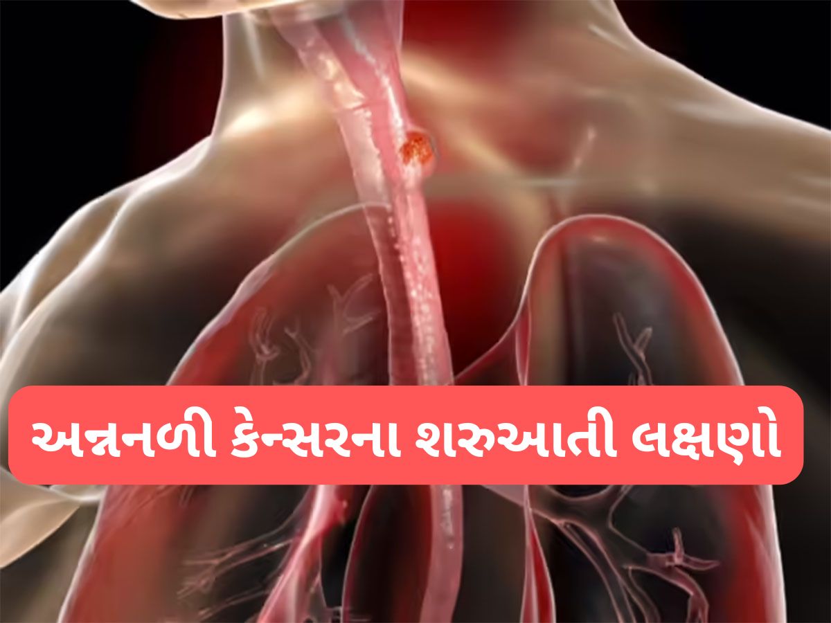 Cancer: અન્નનળીમાં કેન્સર વધતું હોય ત્યારે દેખાય આવા લક્ષણો, એસિડીટી સમજી ઈગ્નોર ન કરો Cancer: અન્નનળીમાં કેન્સર વધતું હોય ત્યારે દેખાય આવા લક્ષણો, એસિડીટી સમજી ઈગ્નોર ન કરો