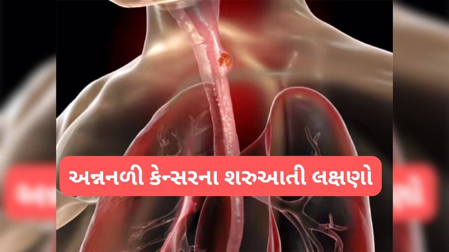 Cancer: અન્નનળીમાં કેન્સર વધતું હોય ત્યારે દેખાય આવા લક્ષણો, એસિડીટી સમજી ઈગ્નોર ન કરો