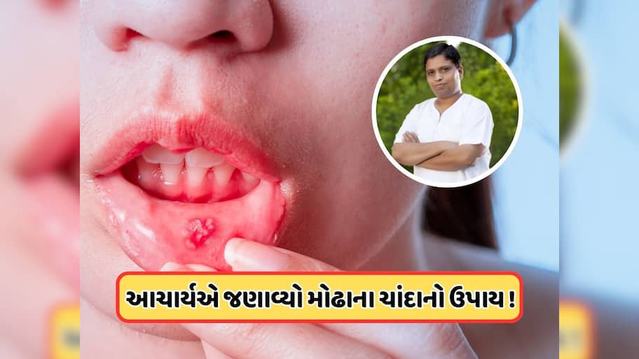 વારંવાર મોઢામાં પડે છે ચાંદા? આચાર્ય બાલકૃષ્ણએ કહ્યું કે આ પાંદડાના પાણીથી કરો કોગળા, તરત જ મળશે રાહત