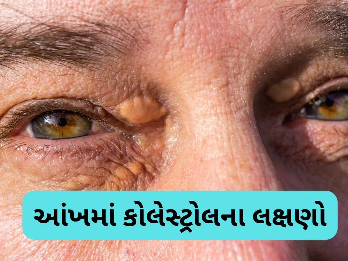 કોલેસ્ટ્રોલ વધવાથી આંખમાં જોવા મળે છે આ 4 લક્ષણ, ગમે ત્યારે બંધ થઈ જશે નસો, નજરઅંદાજ ન કરતા