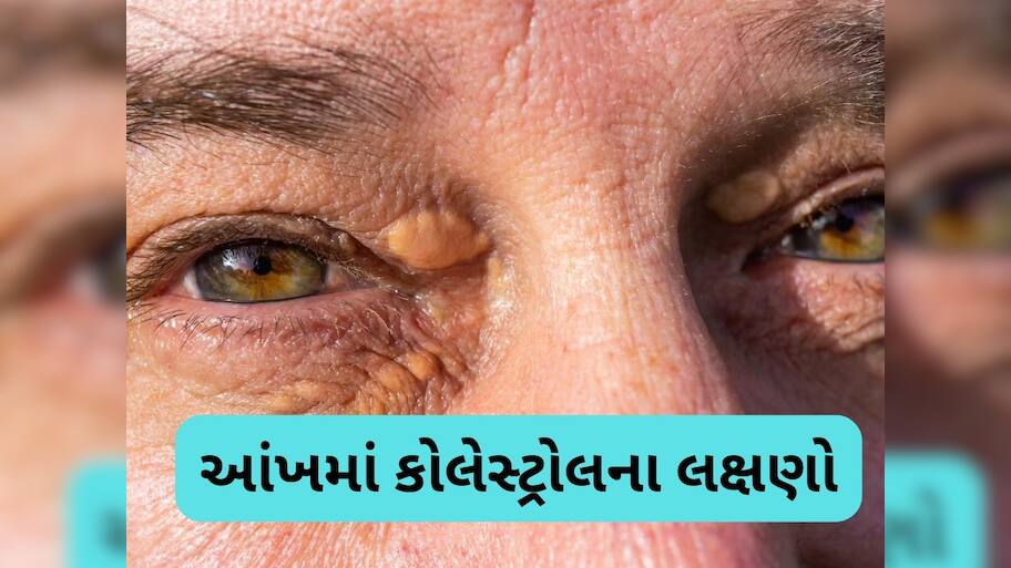 કોલેસ્ટ્રોલ વધવાથી આંખમાં જોવા મળે છે આ 4 લક્ષણ, ગમે ત્યારે બંધ થઈ જશે નસો, નજરઅંદાજ ન કરતા