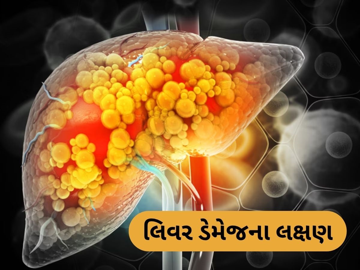 Liver Damage: લિવર ડેમેજનું સૌથી મોટું લક્ષણ, આ સમસ્યા થાય તો ડોક્ટરને જરૂર દેખાડો Liver Damage: લિવર ડેમેજનું સૌથી મોટું લક્ષણ, આ સમસ્યા થાય તો ડોક્ટરને જરૂર દેખાડો