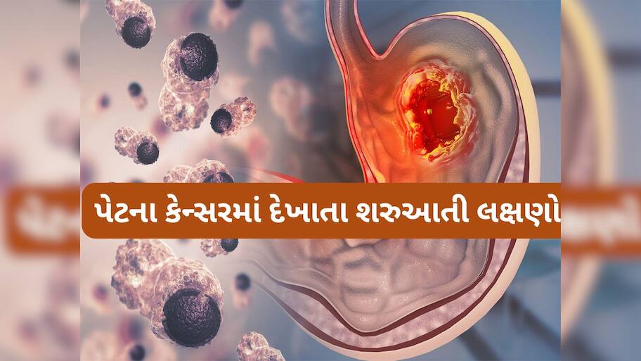 Stomach Cancer: સવારે ઉઠતા વેંત થતી આ 5 સમસ્યા હોય શકે છે પેટમાં કેન્સરની શરુઆત, તુરંત કરવો ડોક્ટરનો સંપર્ક