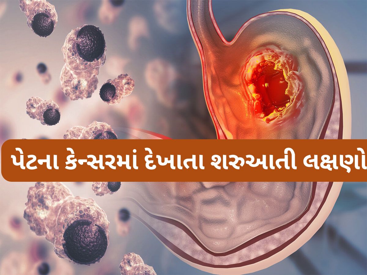 Stomach Cancer: સવારે ઉઠતા વેંત થતી આ 5 સમસ્યા હોય શકે છે પેટમાં કેન્સરની શરુઆત, તુરંત કરવો ડોક્ટરનો સંપર્ક Stomach Cancer: સવારે ઉઠતા વેંત થતી આ 5 સમસ્યા હોય શકે છે પેટમાં કેન્સરની શરુઆત, તુરંત કરવો ડોક્ટરનો સંપર્ક