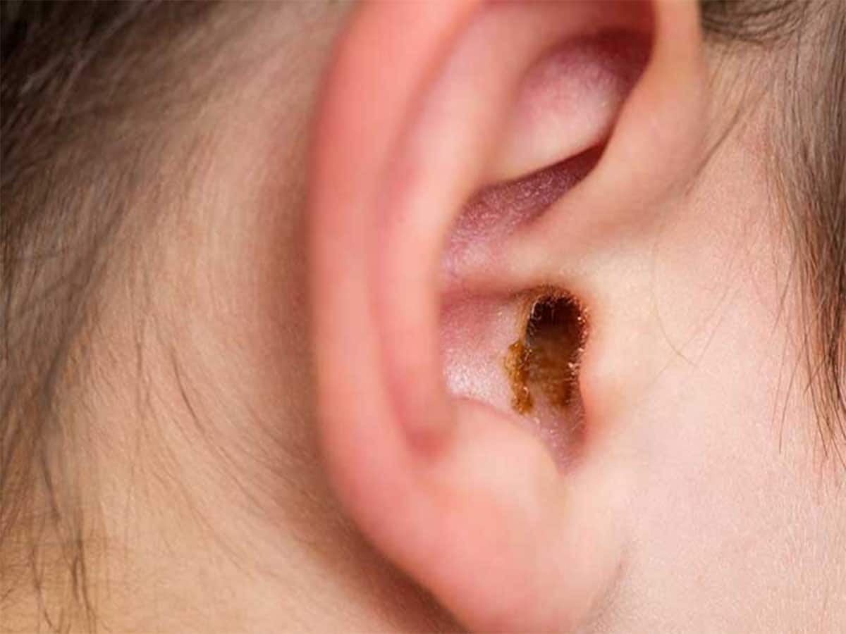 Ladybug In Ear how to remove centipede from ear | કાનમાંથી કાનખજૂરો કાઢવા શું કરવું ...