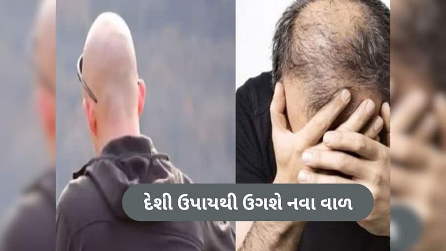ટાલમાં ઉગી જશે નવા વાળ! બસ અપનાવો આ 3 ઘરેલું ઉપાય, ફટાફટ થશે હેર ગ્રોથ