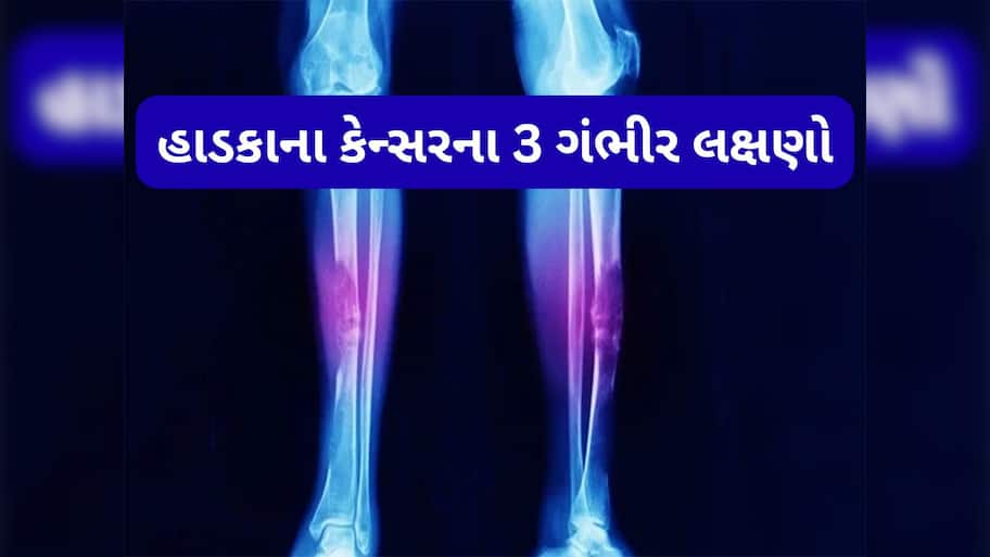 Bone Cancer: હાડકાનું કેન્સર ગંભીર સ્ટેજમાં પહોંચે ત્યારે દેખાય છે આ લક્ષણ, શરીરના આ ભાગમાં થાય અસહ્ય દુખાવો
