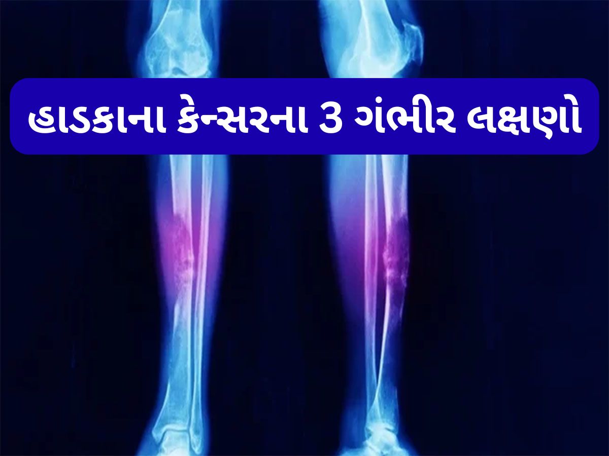 Bone Cancer: હાડકાનું કેન્સર ગંભીર સ્ટેજમાં પહોંચે ત્યારે દેખાય છે આ લક્ષણ, શરીરના આ ભાગમાં થાય અસહ્ય દુખાવો Bone Cancer: હાડકાનું કેન્સર ગંભીર સ્ટેજમાં પહોંચે ત્યારે દેખાય છે આ લક્ષણ, શરીરના આ ભાગમાં થાય અસહ્ય દુખાવો