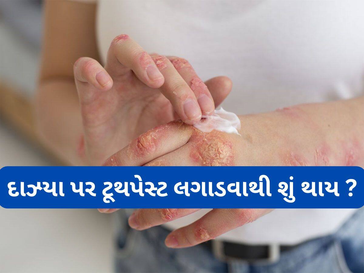 Burn Injuries: દાઝ્યા પર ટુથપેસ્ટ લગાડવી કે નહીં ? જાણો બળેલી ત્વચા પર સૌથી પહેલા શું લગાડવું ?