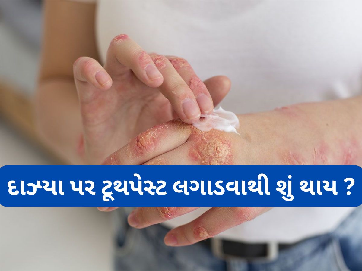 Burn Injuries: દાઝ્યા પર ટુથપેસ્ટ લગાડવી કે નહીં ? જાણો બળેલી ત્વચા પર સૌથી પહેલા શું લગાડવું ? Burn Injuries: દાઝ્યા પર ટુથપેસ્ટ લગાડવી કે નહીં ? જાણો બળેલી ત્વચા પર સૌથી પહેલા શું લગાડવું ?