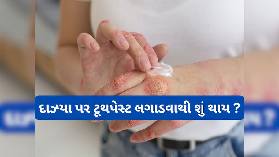 Burn Injuries: દાઝ્યા પર ટુથપેસ્ટ લગાડવી કે નહીં ? જાણો બળેલી ત્વચા પર સૌથી પહેલા શું લગાડવું ?