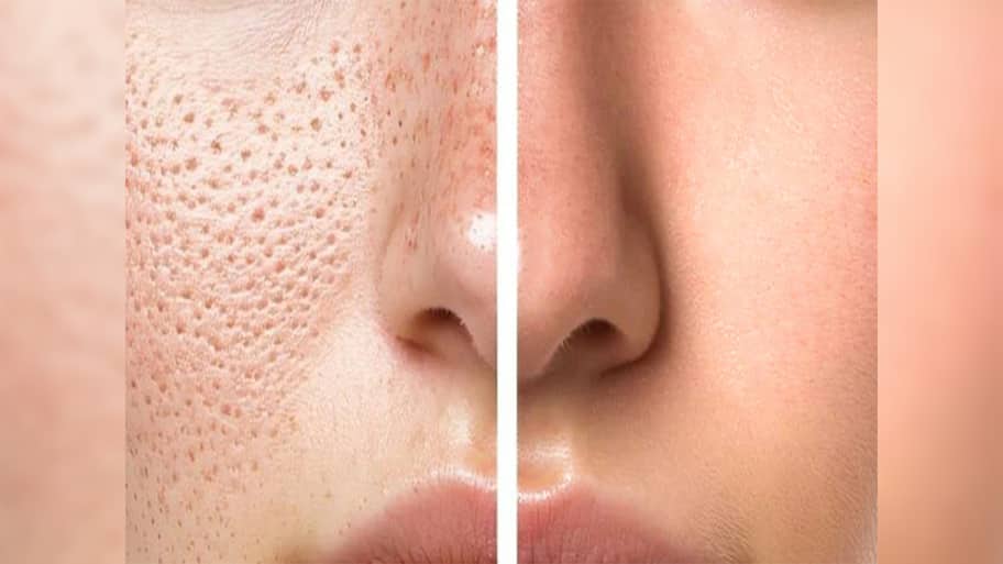 Open Pores: મુલતાની માટીમાં આ 3 વસ્તુઓ મિક્સ કરી લગાડો સ્કિન પર, ઓપન પોર્સ નેચરલી ઓછા થવા લાગશે