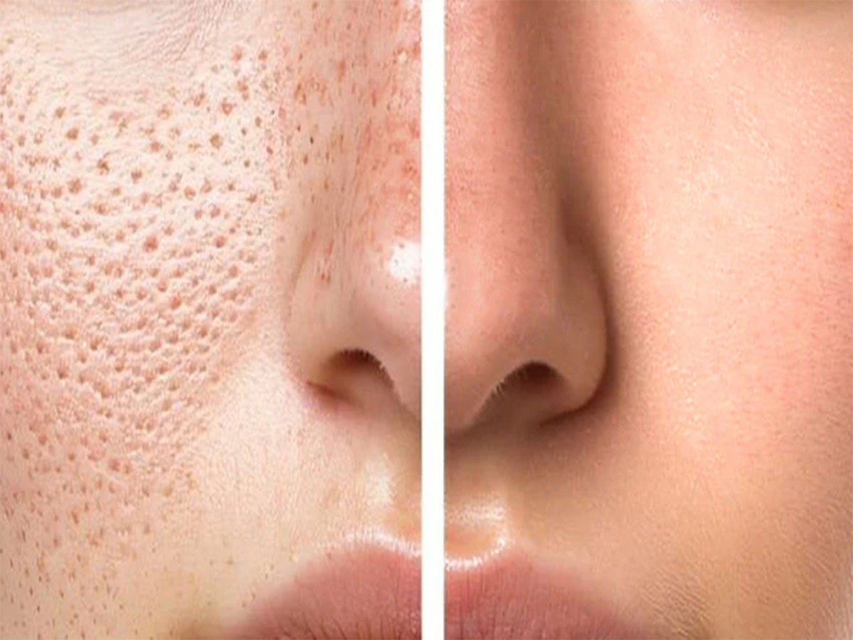 Open Pores: મુલતાની માટીમાં આ 3 વસ્તુઓ મિક્સ કરી લગાડો સ્કિન પર, ઓપન પોર્સ નેચરલી ઓછા થવા લાગશે Open Pores: મુલતાની માટીમાં આ 3 વસ્તુઓ મિક્સ કરી લગાડો સ્કિન પર, ઓપન પોર્સ નેચરલી ઓછા થવા લાગશે