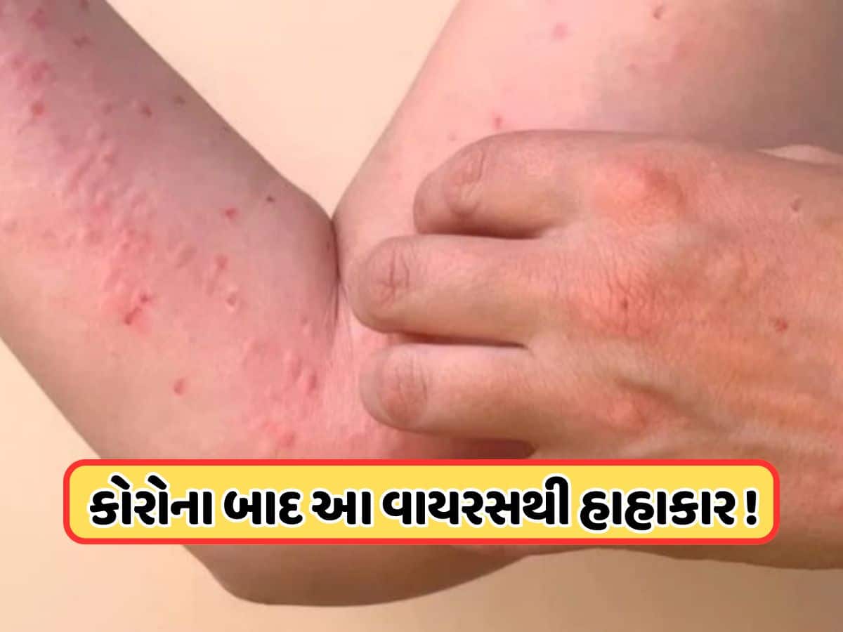 દુનિયાભરમાં ફરી વાગી ખતરાની ઘંટી! કોરોના પછી હવે આ વાયરસ મચાવી રહ્યો છે તબાહી, 2 લાખ લોકો બન્યા ભોગ