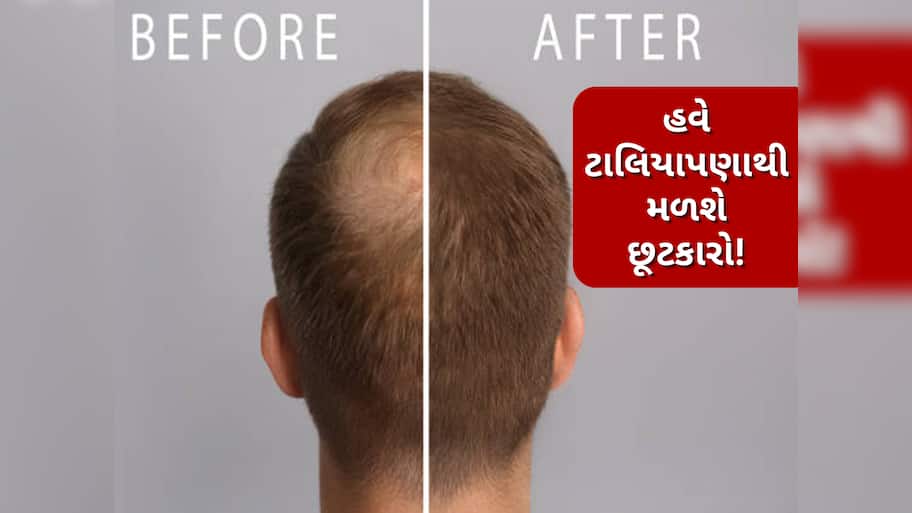 Baldness Treatment: ટાલ પડવી પરમેનેન્ટ નથી, વૈજ્ઞાનિકનો દાવો- હવે સર્જરી અને દવા વગર પોસિબલ છે હેર રિગ્રોથ
