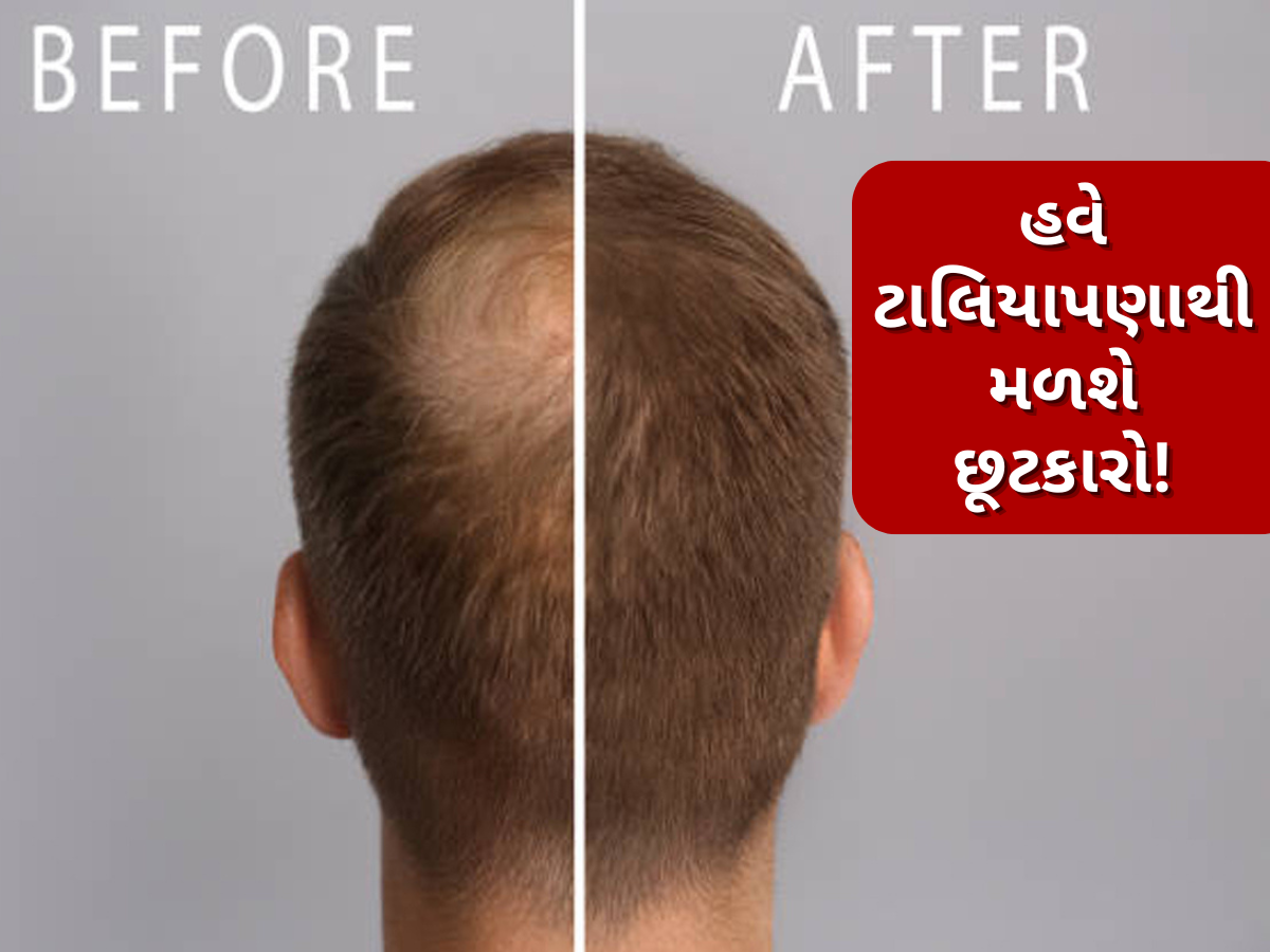 Baldness Treatment: ટાલ પડવી પરમેનેન્ટ નથી, વૈજ્ઞાનિકનો દાવો- હવે સર્જરી અને દવા વગર પોસિબલ છે હેર રિગ્રોથ Baldness Treatment: ટાલ પડવી પરમેનેન્ટ નથી, વૈજ્ઞાનિકનો દાવો- હવે સર્જરી અને દવા વગર પોસિબલ છે હેર રિગ્રોથ