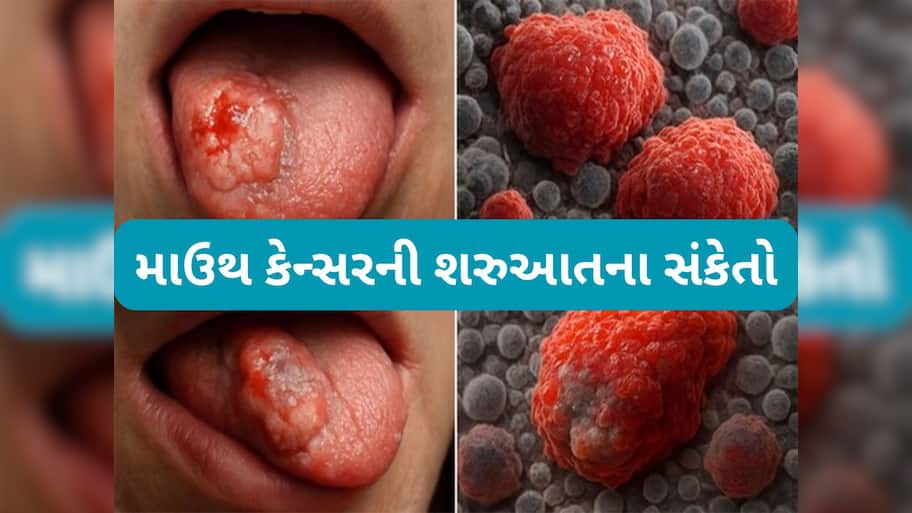 Oral Cancer: મોઢામાં કેન્સર થયું હોય તો શરુઆતમાં દેખાય આ 8 સંકેત, સામાન્ય ગણી ઈગ્નોર ન કરવા આ લક્ષણોને